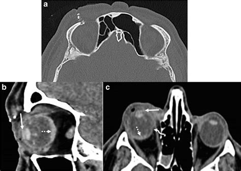 Right Open Globe Injurypenetrating Trauma A Right Preseptal Soft