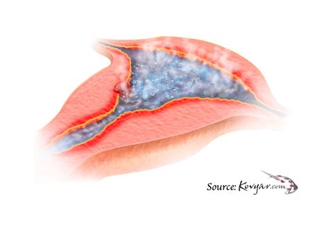 Uterine Artery Embolisation Adenomyosis Treatment Sydney Fibroid Clinic