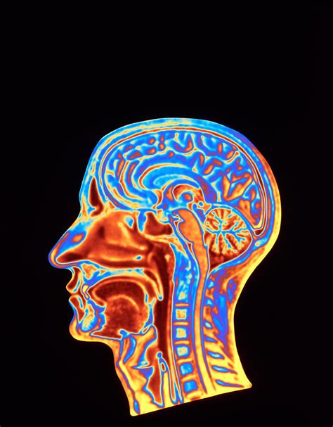 Coloured Mri Scan Of The Human Head Side Photograph By Pasieka Fine