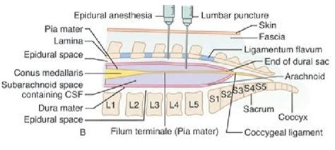 Improved Lumbar Puncture And Epidural Accuracy 20160281 University