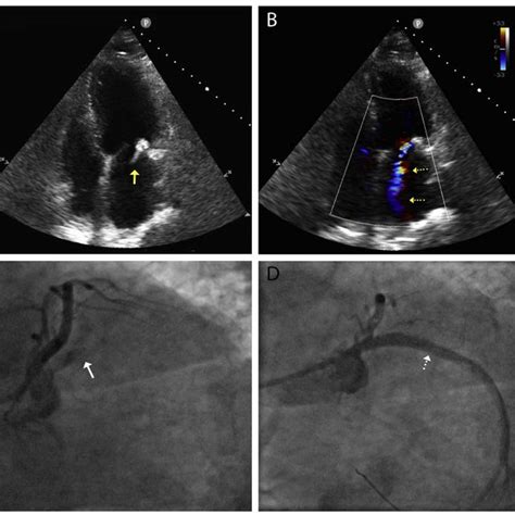 A Transthoracic Echocardiogram Tte Shows Flail Posterior Mitral