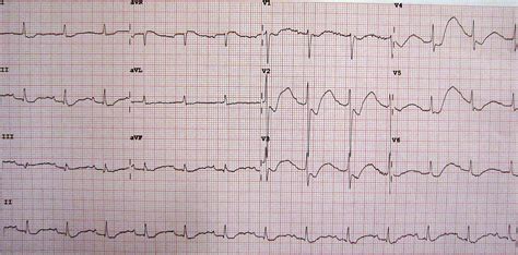 Hypokalemia And Ecg Changes Images And Photos Finder