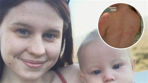 Aquagenic Urticaria Brisbane Mum 22 Living With An Extremely Rare