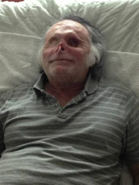 ‘miami zombie victim ronald poppo happily recovering after skin grafts [video graphic photos]