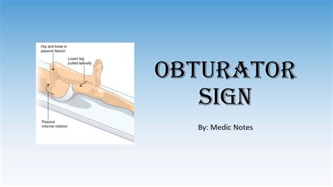 Obturator Sign Pathophysiology Youtube