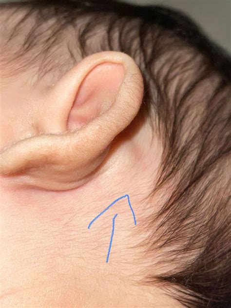 Swollen Lymph Nodes Behind Ear