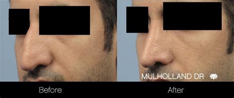 Rhinoplasty For Bulbous Nose Tip Causes And Treatment