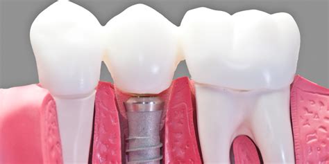 Caring For Your Dental Implants Post Surgery Cosmetic Dentist Dr
