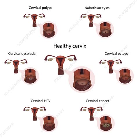 cervical diseases and healthy cervix illustration stock image f028 0224 science photo library