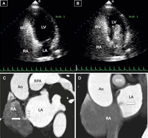 Imaging Of Atrial Septal Defects Echocardiography And Ct Correlation