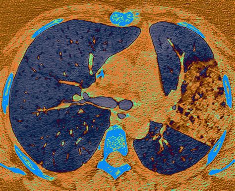 Bacterial Pneumonia Ct Scan Stock Image C0482978 Science Photo