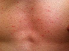 Red Bumps On Chest Back Stomach Babe Itchy Raised Bumps On Chest Not Itchy Red Bumps