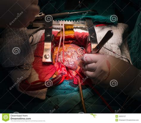 She needs open heart surgery for aneurysms of the aorta due to marfan syndrome. Right atrium stock image. Image of professional, forceps ...