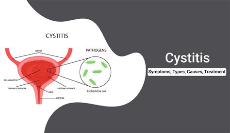 Cystitis Symptoms Types Causes And Treatment