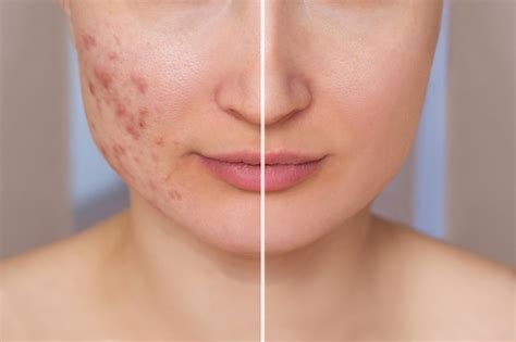 Acne Before After Images Search Images On Everypixel