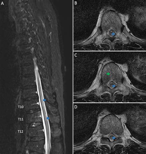 Cureus Spinal Cord Infarction Mimicking Acute Transverse Myelitis
