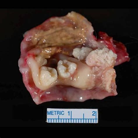 A Dermoid Cyst Or Teratoma In The Ovary Typically Contains A Diversity