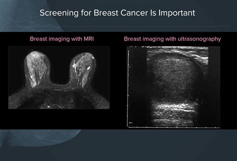 Mammography Screening Guidelines Free Download Nude Photo Gallery