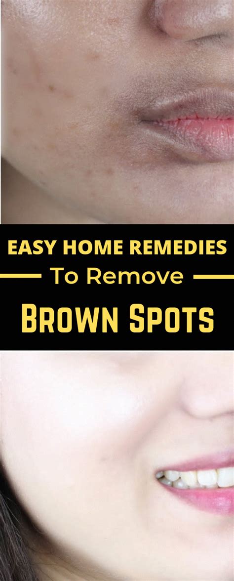Tips On How To Clear Away Brown Spots On Facial Area Naturally Brownsunspotsonface Brown