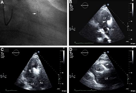Alcohol Septal Ablation For Obstructive Hypertrophic Cardiomyopathy