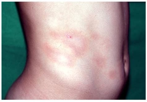 Dermatopathology Free Full Text Annular Lichenoid Dermatitis Of Youth
