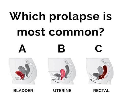 What Does A Prolapse Look Like In A Woman Pelvic Organ Prolapse Nhs