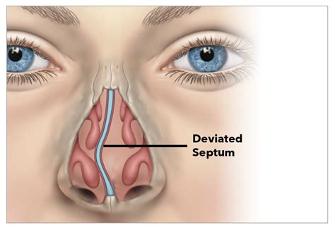 Symptoms Of Deviated Septum In Houston Texas Sinus Snoring