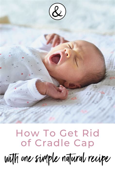 How To Get Rid Of Cradle Cap With One Simple Natural Remedy In 2020