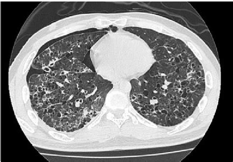 High Resolution Ct Image Of The Thorax Shows Bizarre Thin Walled Cysts