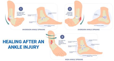 Ankle Sprains 101 Causes Symptoms And Treatment Sol F