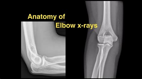 Anterior Elbow Anatomy Bone