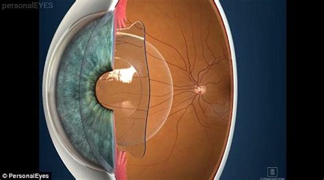 Icl Vision Correction Saw A Surgeon Insert A Contact Lens Inside My Eyeball Daily Mail Online