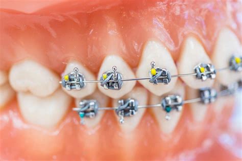 Customized Braces And Orthodontic Treatment For Adults And Children