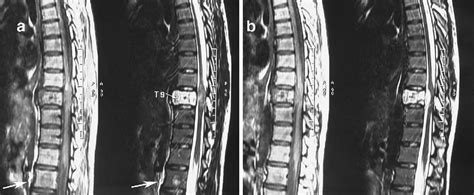 A And B Sagittal T1 Weighted Left And T2 Weighted Right Sequence