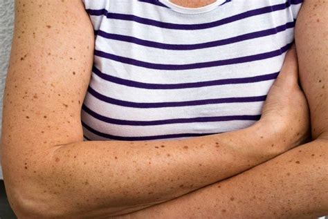 Causes Of Skin Cancer Skin Cancer Risk Factors Readers Digest