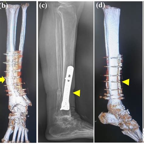 Valgus Malalignment Of The Tibia As Revealed By A A Standing