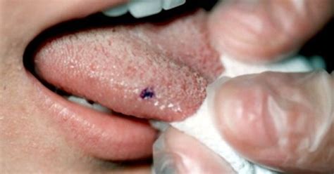 Causes Of Black Spots On Tongue Living In Well Being