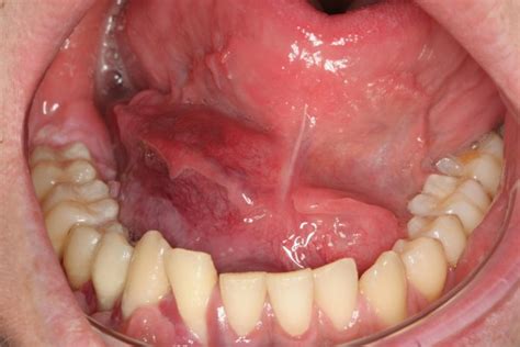 Intraoral Photograph Taken At Initial Examination Showing The Tumour