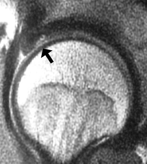 Mri Findings Of Femoroacetabular Impingement Ajr