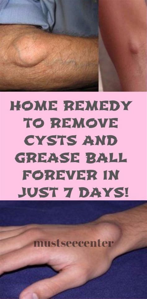 Must See Center Home Remedies How To Remove Cysts