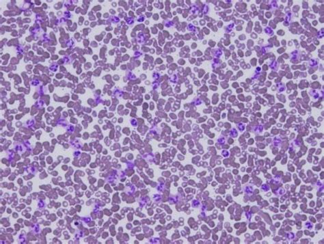Peripheral Smear Shows Marked Granulocytosis Without Any Bands