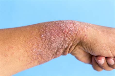 How I Healed Eczema The Natural Way Your Super De