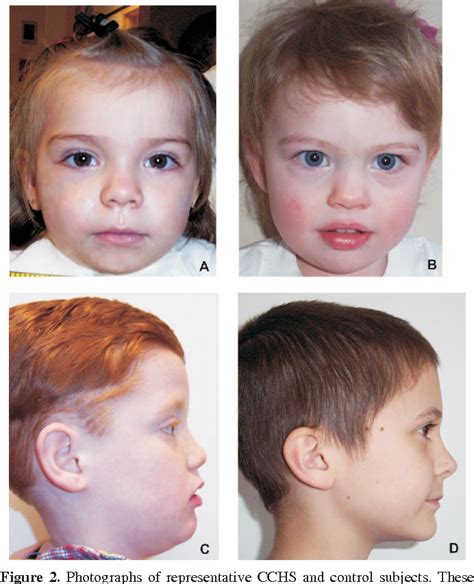 Figure 1 From Facial Phenotype In Children And Young Adults With Phox2b