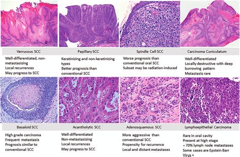 Oral Cavity Histologic Subtypes Of Squamous Cell Carcinoma