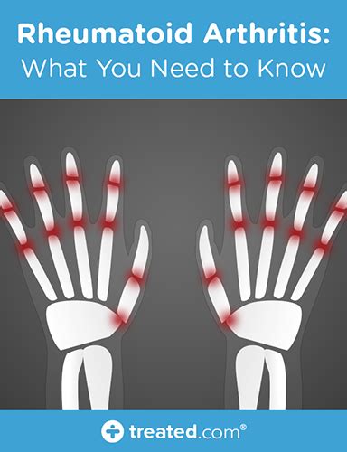 Rheumatoid Arthritis What You Need To Know Nras