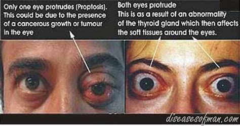 Exophthalmos Protrusion Of The Eyes Also Known As Exophthalmia Or
