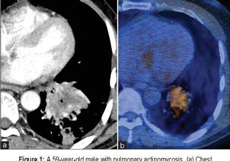 Figure 1 From Pulmonary Actinomycosis Mimicking Lung Cancer On Positron