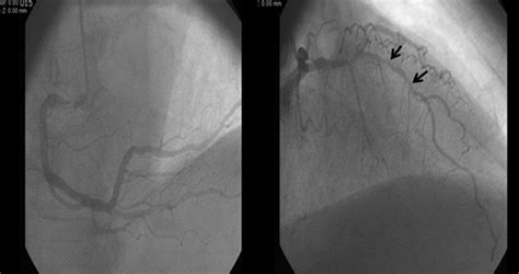 Successful Management Of Grade Iii Coronary Perforation After