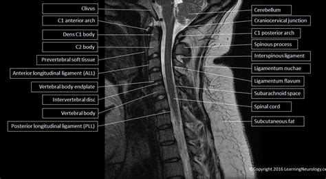 Sagittal Mri C Spine T2 With Structures Labeled Mri Mri Study Mri