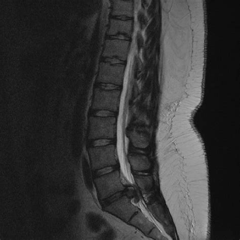 Why does disc bulge or herniated disc at this level bothers so much with pain, numbness and desiccated discs appear dark in a mri. MRI scan showing massive L5/S1 disc protrusion. | Download Scientific Diagram